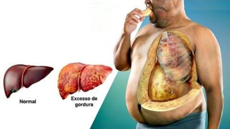 o que é Estradiol: para que serve e como saber se está alto ou baixo-radardasaude 7 Esteatose Hepática pode ser revertida com esse simples tratamento...